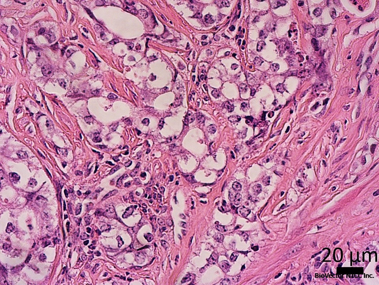 Novel poorly differentiated endometrial cancer mouse model ...