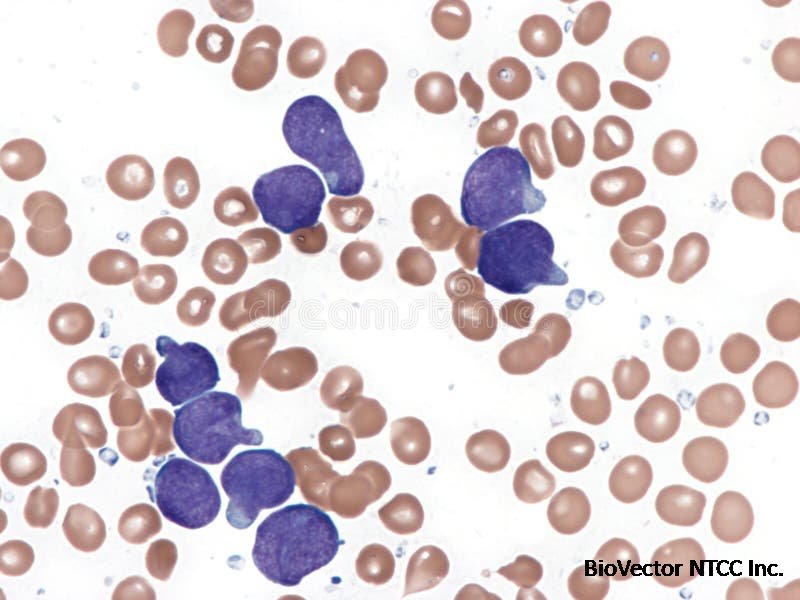 T-cell Acute Lymphoid Leukemia. Bone Marrow. Stock Photo - Image of  lymphocytes, lymphoblastic:349353254
