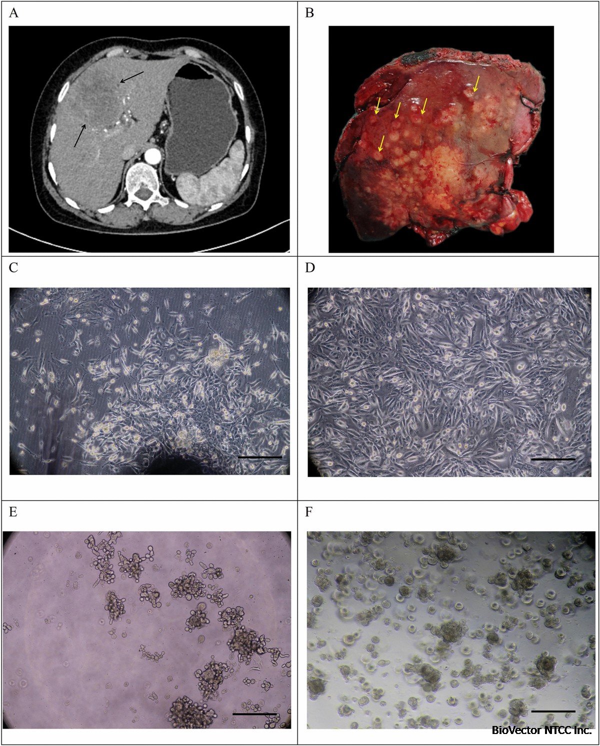 Establishment and characterization of a new intrahepatic cholangiocarcinoma  cell line, ICC-X3 | Human Cell