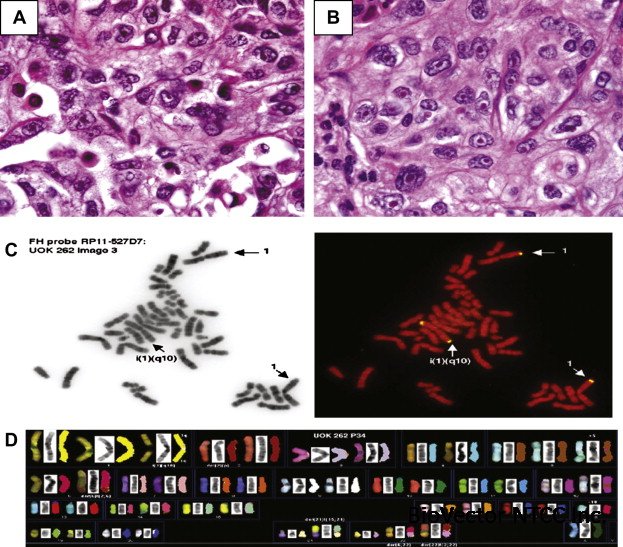 UOK 262 cell line, fumarate hydratase deficient (FH−/FH−) hereditary  leiomyomatosis renal cell carcinoma:in vitro and in vivo model of an  aberrant energy metabolic pathway in human cancer - ScienceDirect