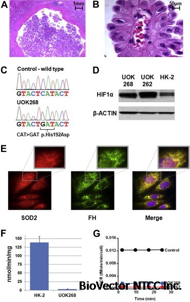 A novel fumarate hydratase-deficient HLRCC kidney cancer cell line, UOK268:a model of the Warburg effect in cancer - ScienceDirect